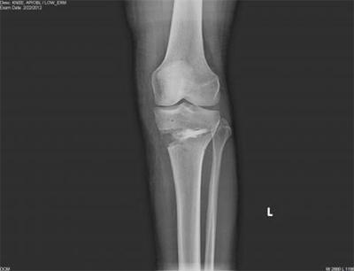 Post-operative AP X-ray of the knee after HTO with the iBalance system.