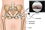 How Effective Is Hip Arthroscopy for Treating Hip Injuries in New York?