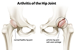 What Are the Early Signs You Need an Orthopaedic Hip Preservation Surgeon in New Jersey?