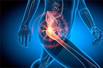 Who Is the Best Hip Arthroscopy Surgeon in New Jersey?