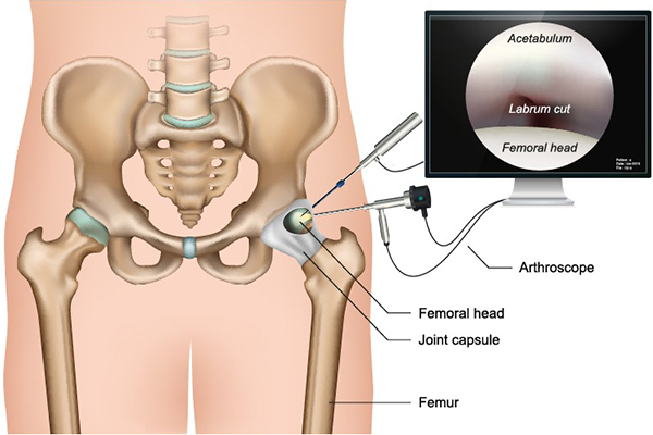 How Effective Is Hip Arthroscopy for Treating Hip Injuries in New York?