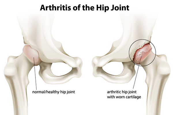 What Are the Early Signs You Need an Orthopaedic Hip Preservation Surgeon in New Jersey?