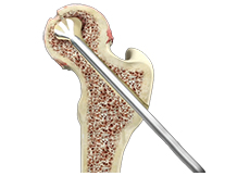 Arthroscopic Assisted Core Decompression of the Hip