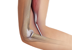 Biceps Tendon Tear