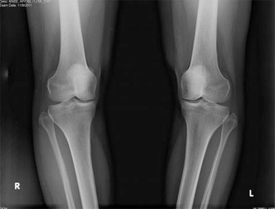Pre-operative x-rays of bilateral varus (bow-legged) knees