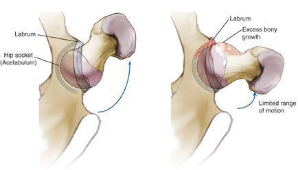 cam-impingement