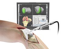 Computer Assisted Hip and Knee Joint Replacement