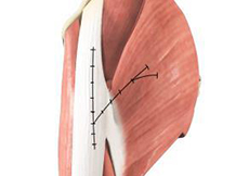 Gluteus Maximus Transfer