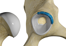 Hip Labral Reconstruction