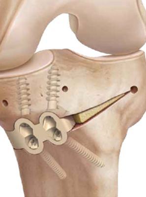 A picture of a HTO using the iBalance implant and screws 