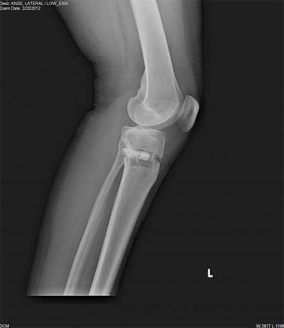 Post-operative Lateral X-ray of the knee after HTO with the iBalance system.