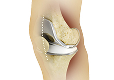 Minimally Invasive Joint Replacement