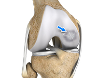 Osteochondral Defect (OCD)