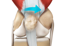 Patella Stabilization