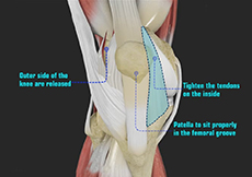 Patellafemoral Realignment