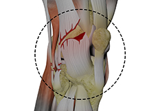 Posterolateral Instability