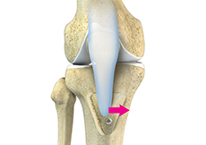 Tibial Tubercle Osteotomy