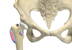 Trochanteric Bursitis