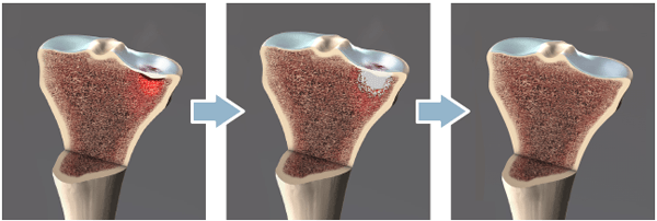 subchondroplasty scp