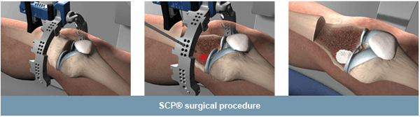 subchondroplasty scp