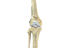Distal Femoral Osteotomy (DFO)