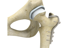 Femoral Derotational Osteotomy