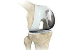 Unicondylar (Unicompartmental) Knee Replacement